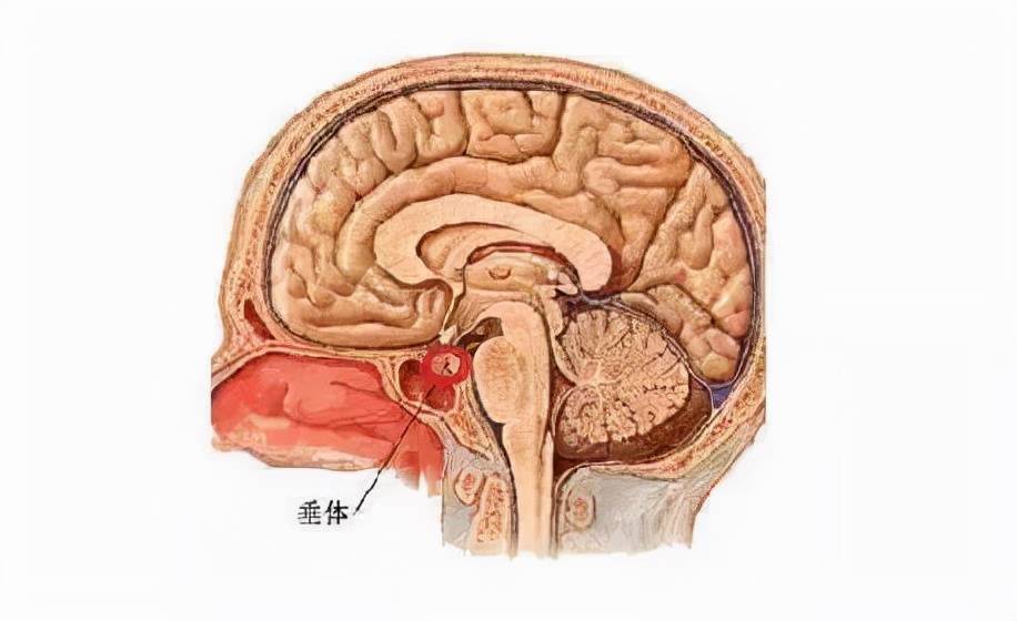 垂體瘤圖片