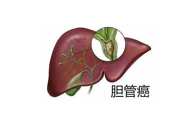膽管癌圖片