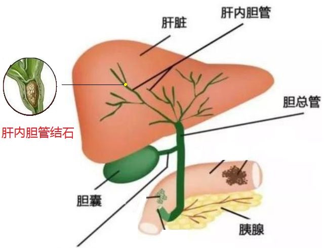 膽管癌圖片